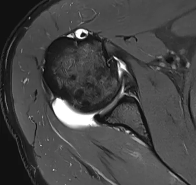Anterior glenoid labral tear