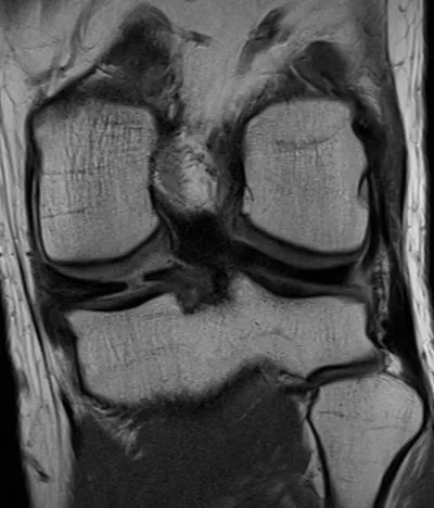 Radial tear posterior horn medial meniscus