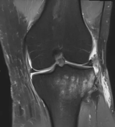 Lateral meniscocapsular ligament injury