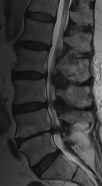 Lumbar spinal canal stenosis
