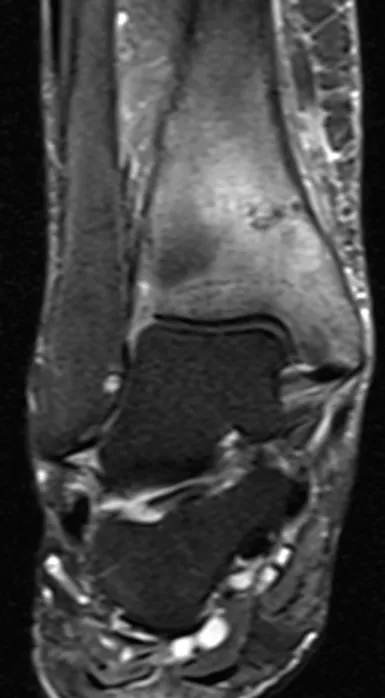 Tibial stress fracture