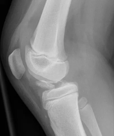 ACL footprint avulsion