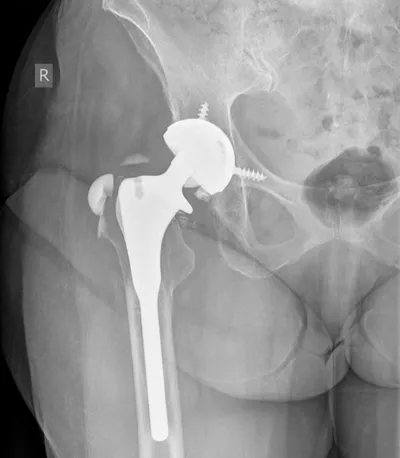 Shattered ceramic femoral head arthroplasty