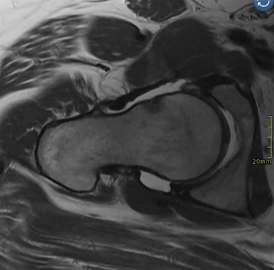 Cam morphology of proximal femur (FAI)