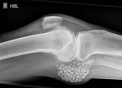 Synovial osteochondromatosis in a Baker's cyst