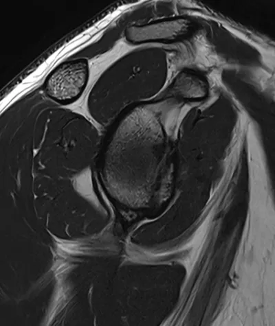 Bony Bankart injury of glenoid