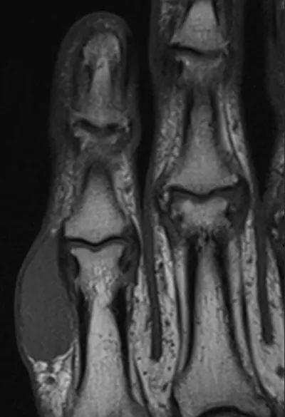 Giant cell tumor of tendon sheath