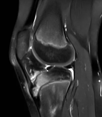 Osgood Schlatter Apophysitis