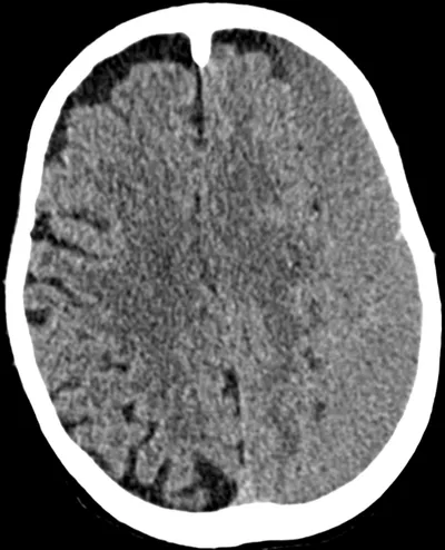 Subdural haematoma