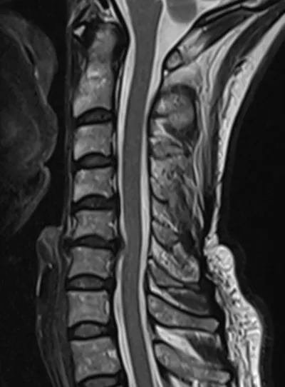 Disc osteophyte protrustion C5-C6