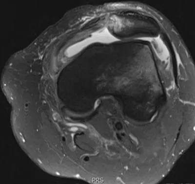 Transient patellar dislocation