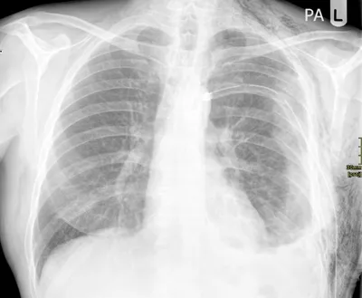 Surgical emphysema - left sided rib fractures