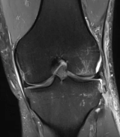 Segond fracture