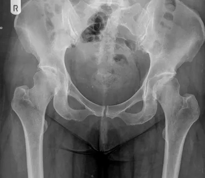 Pistol Grip proximal femora - dysplastic hips