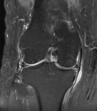 Pes anserenius bursitis