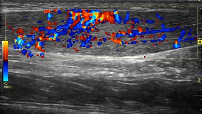 Achilles tendinopathy