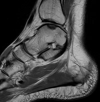 Osteochondral lesion of talus