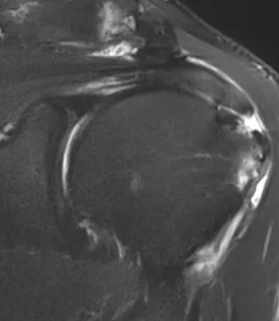 Rim rent tear of distal supraspinatus tendon