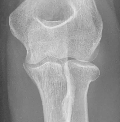 Radial neck fracture