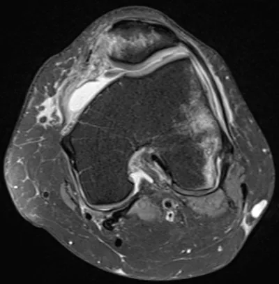Transient lateral patellar dislocation