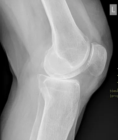 Patella baja
