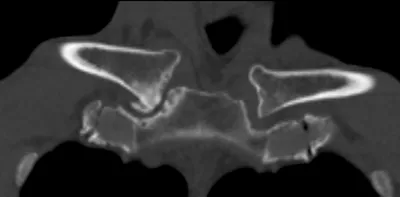 Sternoclavicular joint osteoarthritis