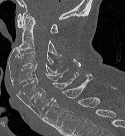 Chalkstick fracture of fused cervical spine