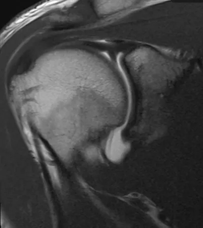 Sublabral recess and Buford complex