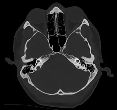 Petrous temporal bone fracture (left)