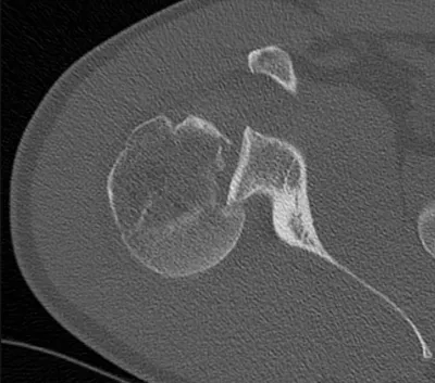 Reverse Hill Sachs lesion