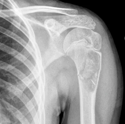 Unicameral bone cyst, pathological fracture, fallen fragment sign