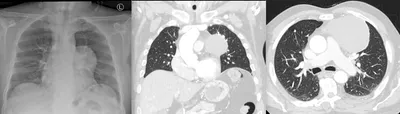 Hilum overlay sign - anterior mediastinal mass