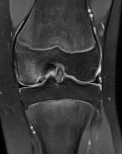 Osteochondritis Dissecans
