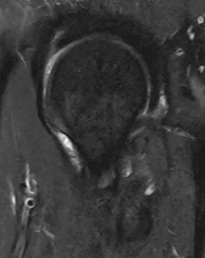 Sagittal cam lesion of femoral head-neck junction