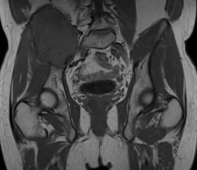 Plasmocytoma of right iliac bone