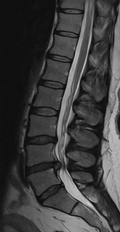 Cauda Equina Compression