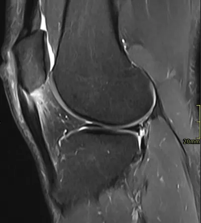 Patellar tendinosis with tear