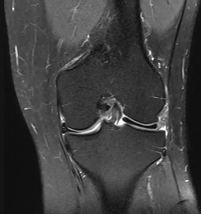 Discoid lateral meniscus