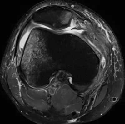 Transient patellar dislocation