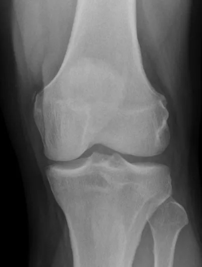 Pellegrini Stieda Lesion