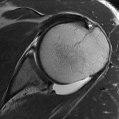 Anterior Labroligamentous Periosteal Sleeve Avulsion (ALPSA) lesion