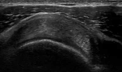 Supraspinatus tendinopathy