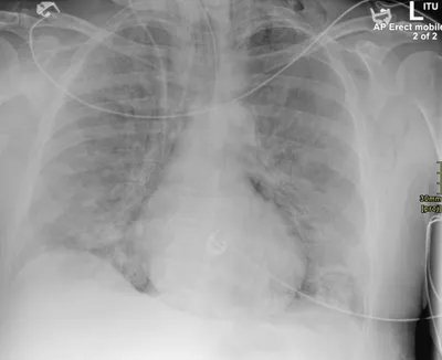 Pneumomediastinum barotrauma