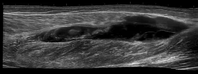Tennis leg - gastrocnaeumius muscle tear and haematoma