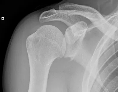 Bankart fracture & Hill Sachs deformity