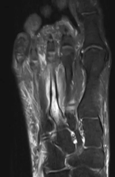 Metatarsal stress fracture