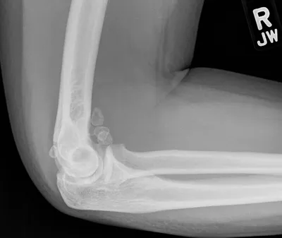 Synovial Osteochondromatosis of Elbow