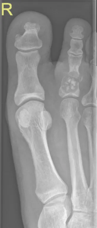 Pathological fracture through enchondroma