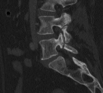 Pars Interarticularis defects