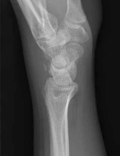 Triquetral fracture dorsal bone fragment